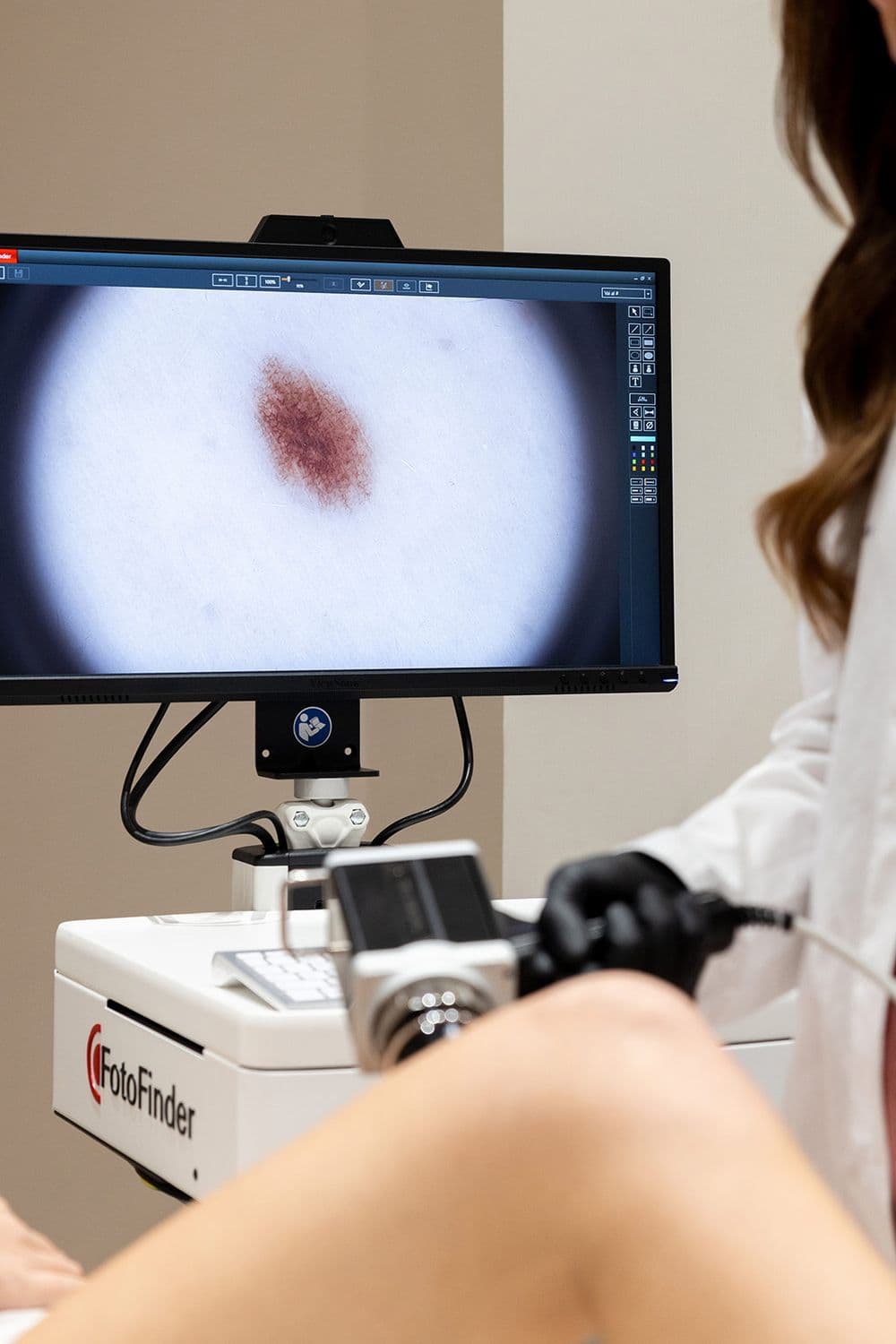 Dermatoscopia digitale per la mappatura dei nei durante una visita dermatologica presso Studio Aimi a Parma