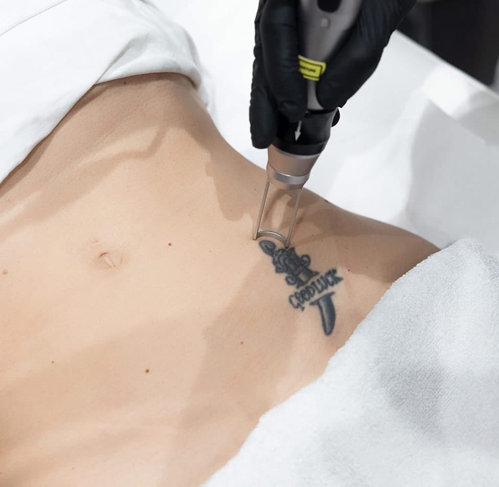 Studio per la Rimozione dei tatuaggi dermatologico